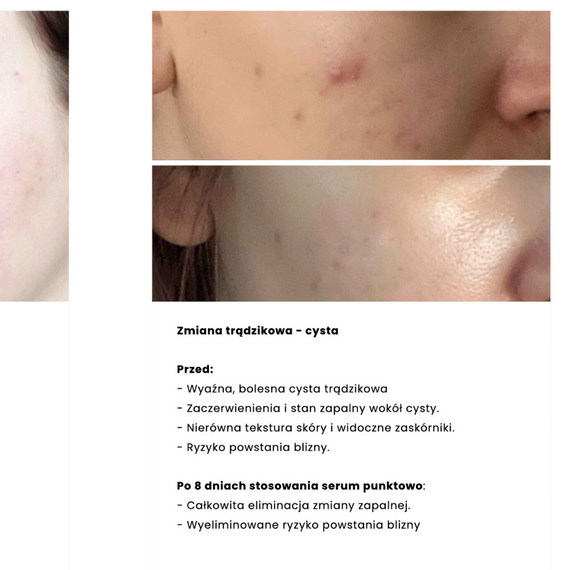 Zestaw MAXI - kosmetyki ze śluzem ślimaka do skóry tłustej i mieszanej - Nature Cosmetics - OILY SKIN