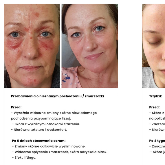 Zestaw MAXI - kosmetyki ze śluzem ślimaka do skóry tłustej i mieszanej - Nature Cosmetics - OILY SKIN